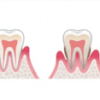 歯医者歯石除去とSRP