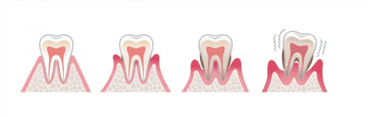 歯医者歯石除去とSRP