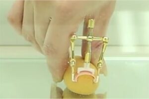 巻き爪治療の巻き爪ロボ